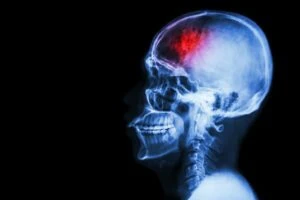 Skull X Ray showing Brain Injury