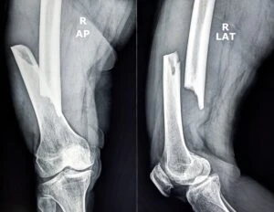 X-Ray showing broken bone