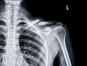 X-ray of shoulder joint show broken bone