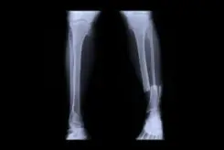 broken leg x-ray