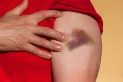 woman’s arm with a bruise