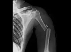 x-ray showing broken arm