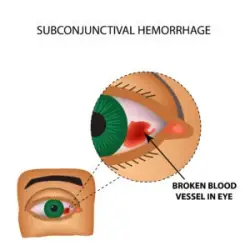 Image of eyes with subconjunctival hemmorrhage