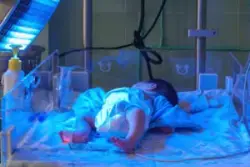 A baby being treated for jaundice at the hospital