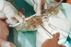 doctor cutting baby’s umbilical cord during birth