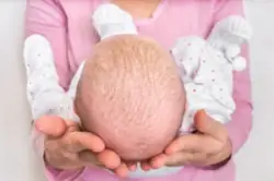 Little-newborn-baby-with-psoriasis-or-dandruff-in-the-hair