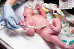 How Rare Are Umbilical Cord Accidents?