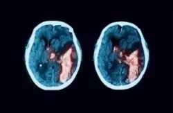 This is a CT scan of a brain hemorrhage. If your child has suffered a brain bleed, speak with our newborn brain hemorrhage lawyers in Chandler, AZ.