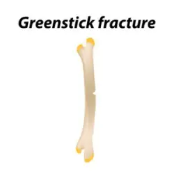 Greenstick fractures are often only seen in infants. If you suspect a broken bone in your infant, contact a birth injury attorney in Gilbert, AZ, by calling us.