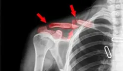 An example of a broken clavicle, the most common broken bone in infants. Call our Maryland broken bones attorneys if your baby received this injury.