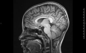 what-is-hypoxic-ischemic-encephalopathy-HIE