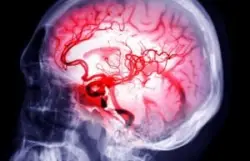 The photo shows a human brain x-ray in Atlanta. Call an Atlanta brain ischemia lawyer now.
