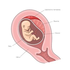 A diagram of a fetus in the womb showing where the placental wall has separated from the uterus. This causes a form of placental abruption.