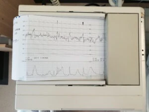 Fetal heart rate monitors like this can prove fetal tachycardia is happening and sometimes what the cause of fetal tachycardia is.