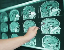 A doctor points to a brain injury on a chart and the victim needs to contact a Mason brain injury lawyer.