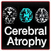 Cerebral Atrophy