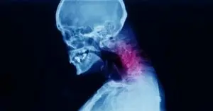 x-ray of neck pain
