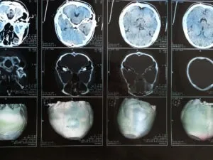 Lilburn Traumatic Brain Injury Lawyer