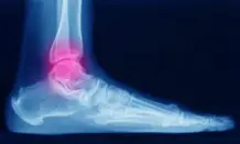 What Is the Average Settlement for Ankle and Foot Pain After a Car Accident?