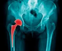 Lafayette Hip Replacement Lawyer