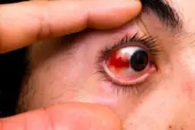 Marksville Eye Injury Lawyer