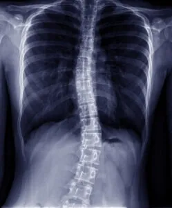 An x-ray of a spine with scoliosis. A lawyer can help you seek Social Security Disability for Scoliosis.