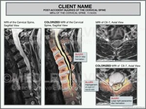 Cervical Disc Herniation: Potential Result of Bellevue Car Accident