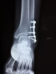 Malleolar Fracture attorneys in Seattle Renton Bellevue and Federal Way