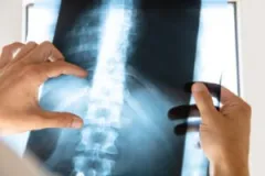 Lafayette, IN, spinal cord injury attorneys can defend your rights in the wake of a dangerous accident.