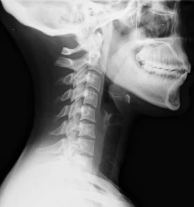 Lateral_neck_X-ray