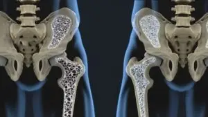 Pittsburgh Osteoporosis Lawyer