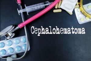 Uniondale Cephalohematoma Lawyer