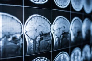 Levittown Brain Injury Lawyer