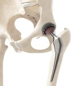 hip replacement joint on a skeleton