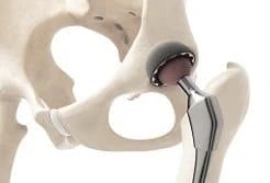 hip replacement joint on a skeleton