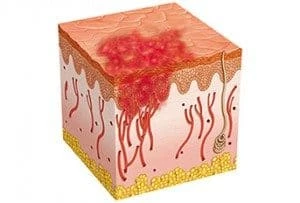 epidermis cross section with a rash on the top of the skin and blood vessels underneath