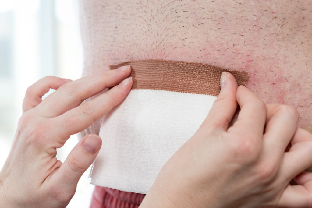 Important Steps to Take After a Hernia Mesh Injury