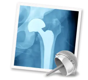 Orthopedic Hip Implants