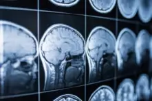 What Factors Are Needed to Prove Negligence With a Brain Injury?