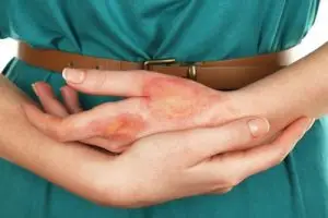 Making an Injury Claim for Burns and Scars after an Accident in Georgia