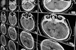 MRI-brain-scan