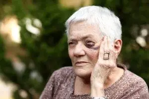 elderly woman touching bruise on face
