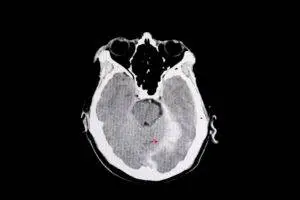 ct scan of patient with tbi
