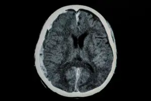 ct scan showing three damaged areas of brain