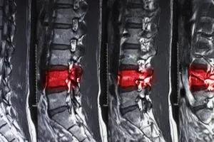An MRI of a spinal injury.