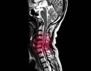 mri of spinal cord compression