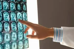 A doctor’s hand pointing to a printout of brain scans.