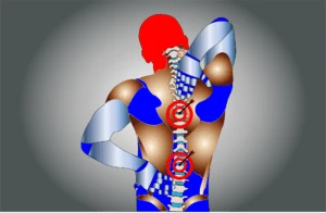 spinal fusions