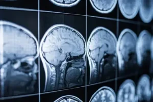 Brain scan images related to traumatic brain injuries