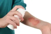 How To Treat Burn Injuries